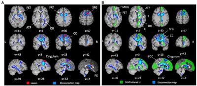 Case report: Multiple disconnection patterns revealed by a multi-modal analysis explained behavior after a focal frontal damage